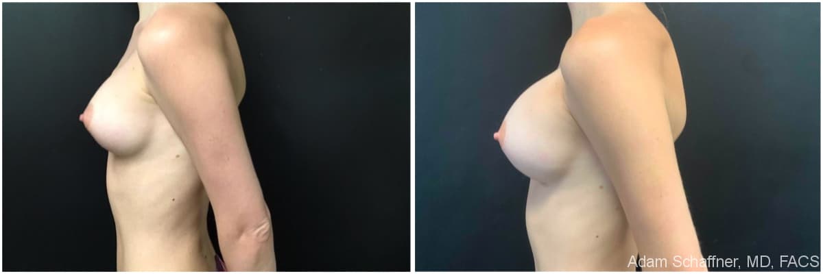 Breast Implants Exchange before and after result — Adam Schaffner, MD, FACS, New York City (case 7)