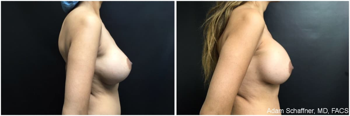 Breast Implants Exchange before and after result — Adam Schaffner, MD, FACS, New York City (case 4)