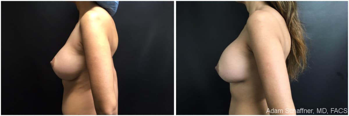 Breast Implants Exchange before and after result — Adam Schaffner, MD, FACS, New York City (case 3)