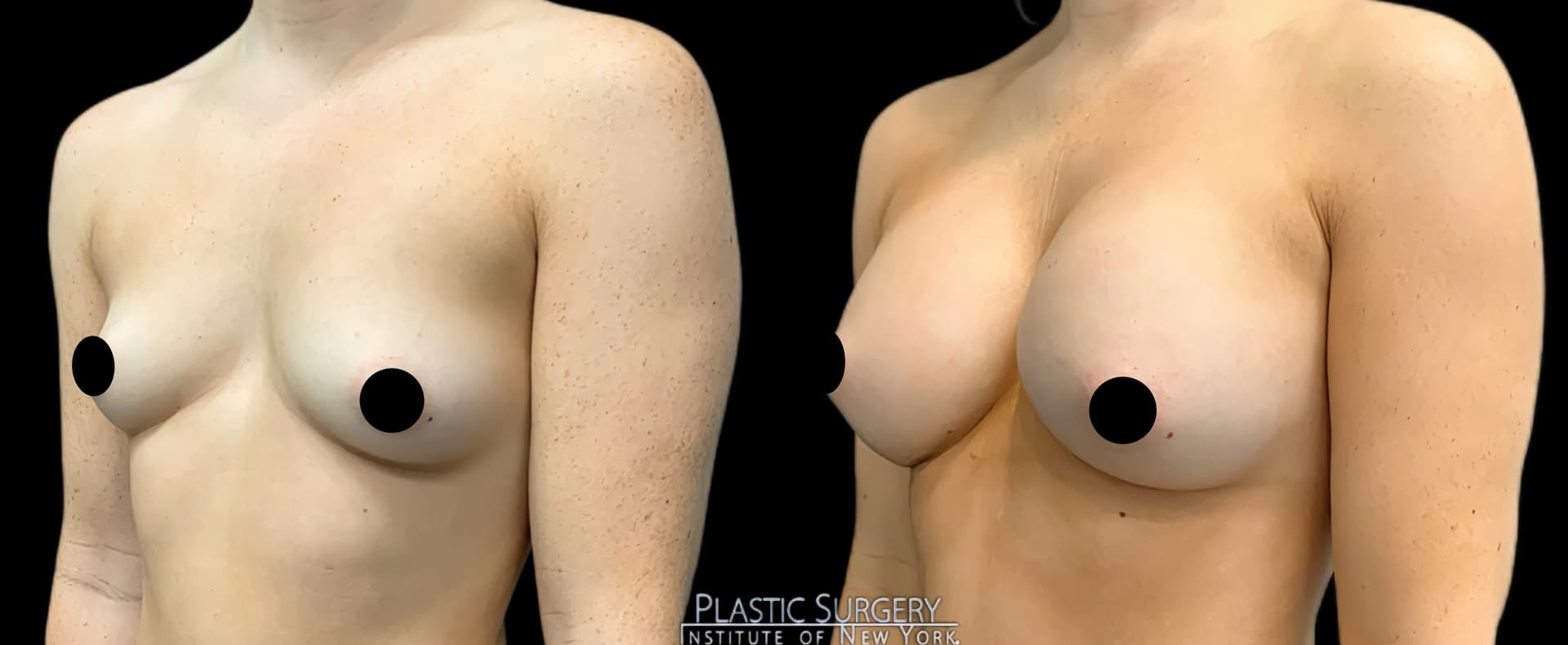 Breast Augmentation before and after result — Adam Schaffner, MD, FACS, New York City (case 14)