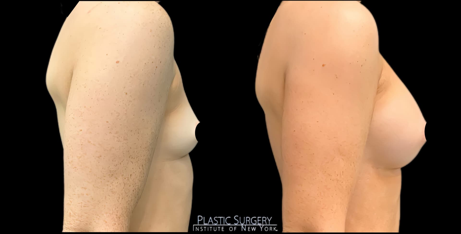 Breast Augmentation before and after result — Adam Schaffner, MD, FACS, New York City (case 13)
