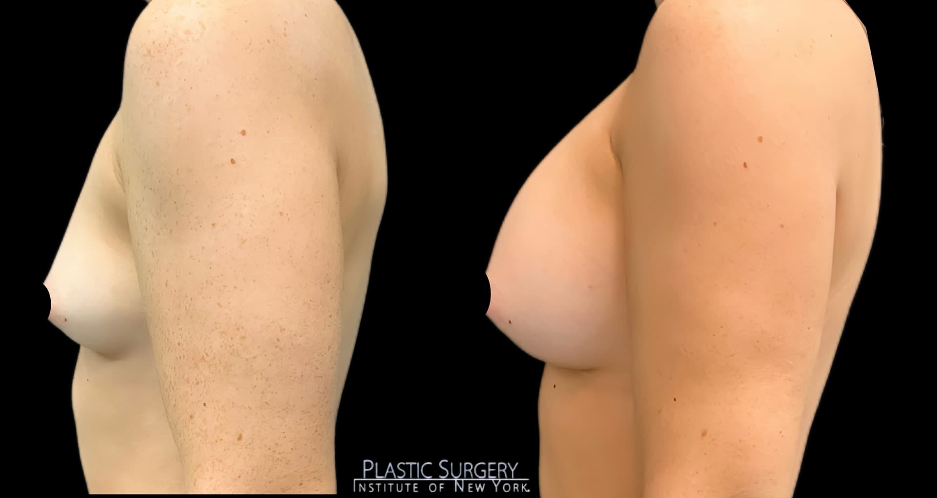 Breast Augmentation before and after result — Adam Schaffner, MD, FACS, New York City (case 12)