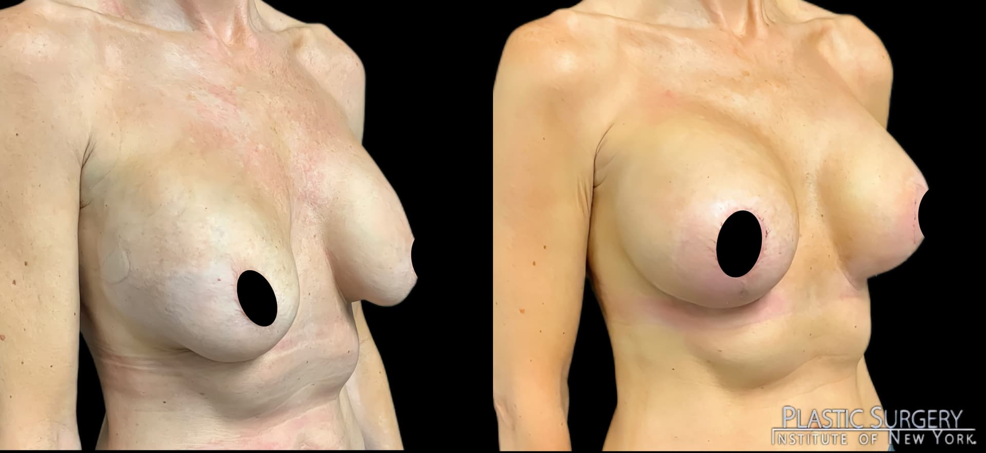 Breast Augmentation before and after result — Adam Schaffner, MD, FACS, New York City (case 8)