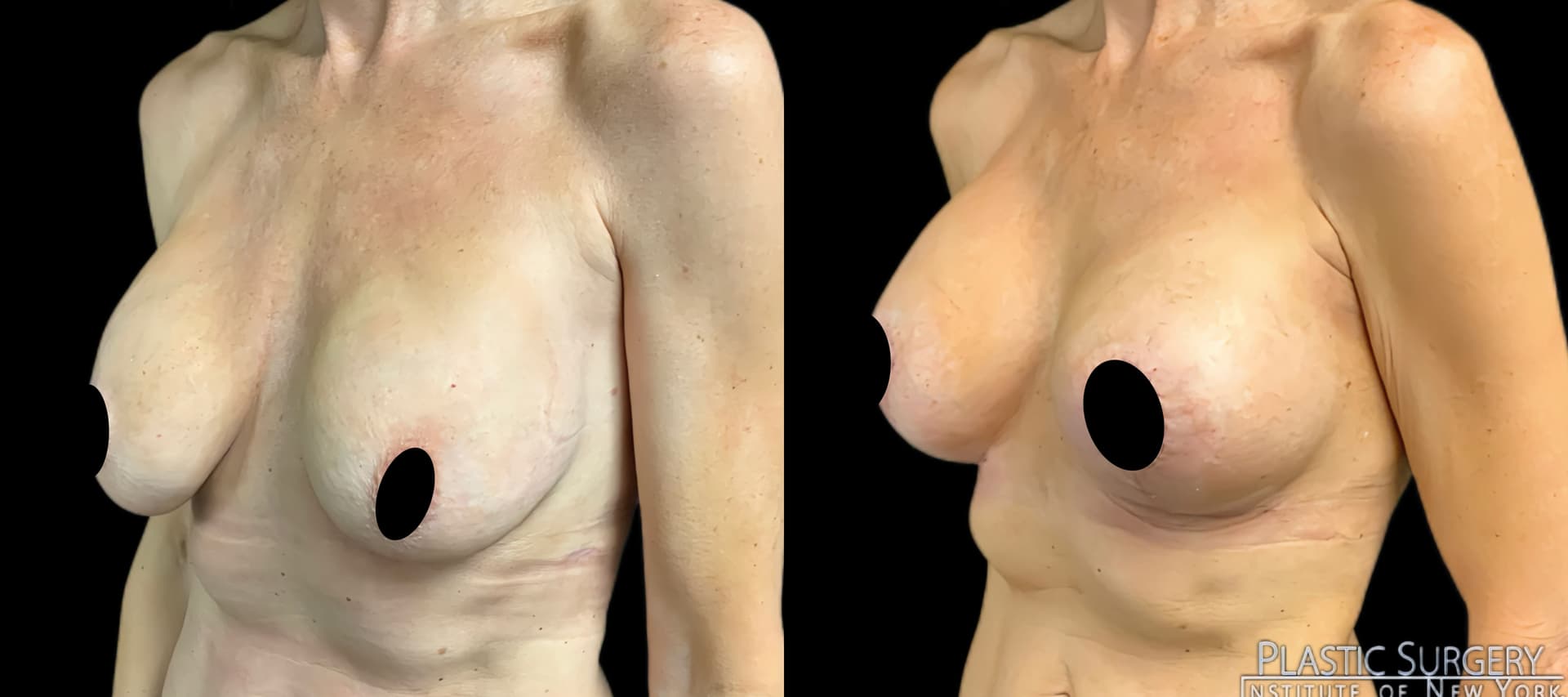 Breast Augmentation before and after result — Adam Schaffner, MD, FACS, New York City (case 7)