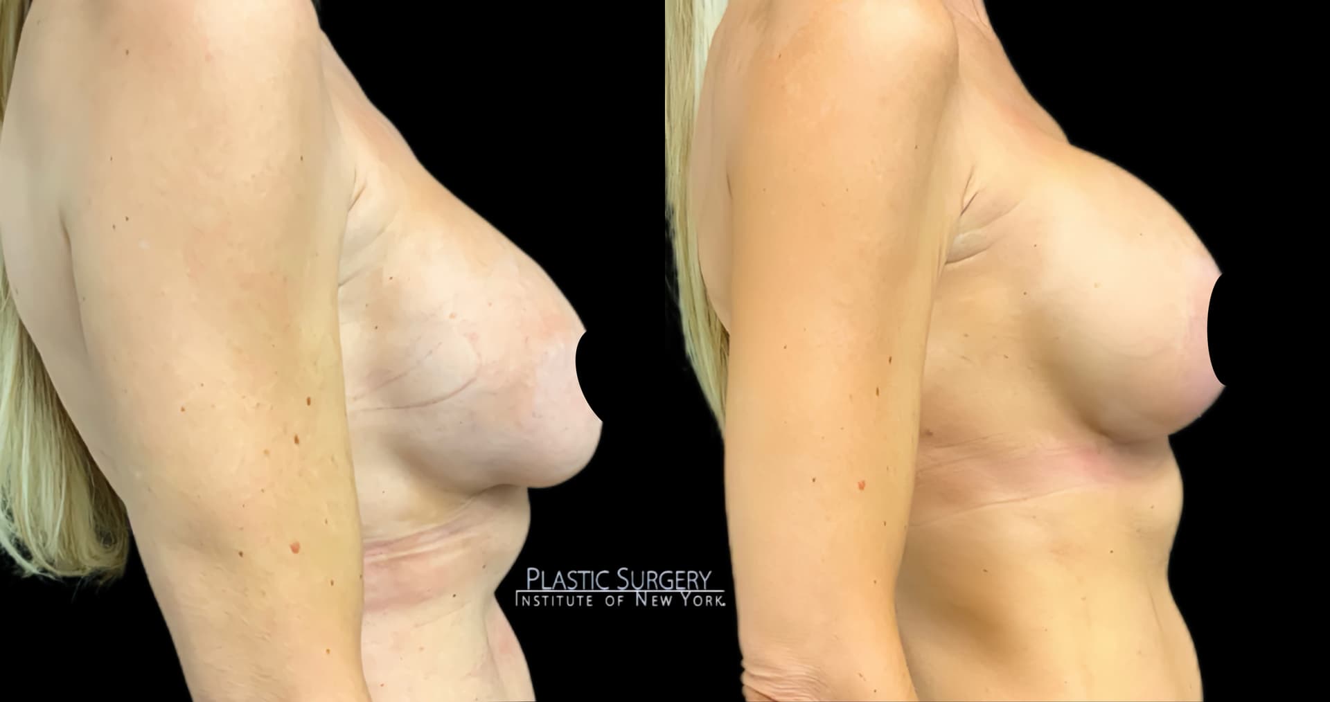 Breast Augmentation before and after result — Adam Schaffner, MD, FACS, New York City (case 9)