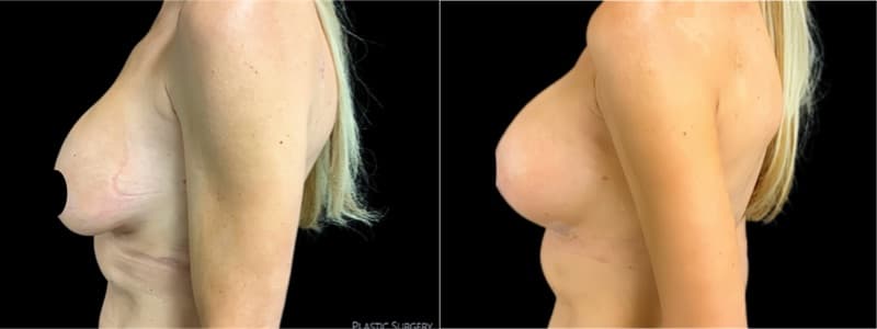 Breast Augmentation before and after result — Adam Schaffner, MD, FACS, New York City (case 10)
