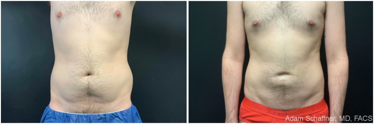 Liposuction with Fat Transfer to Buttocks (BBL – Brazilian Butt Lift) before and after result — Adam Schaffner, MD, FACS, New York City (case 8)