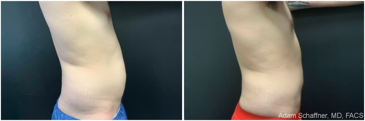 Liposuction with Fat Transfer to Buttocks (BBL – Brazilian Butt Lift) before and after result — Adam Schaffner, MD, FACS, New York City (case 7)