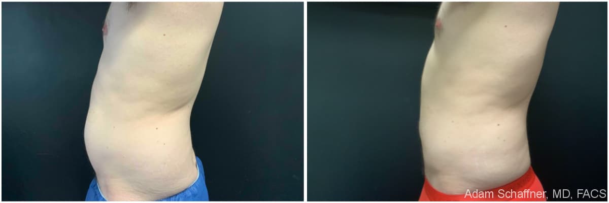 Liposuction with Fat Transfer to Buttocks (BBL – Brazilian Butt Lift) before and after result — Adam Schaffner, MD, FACS, New York City (case 6)