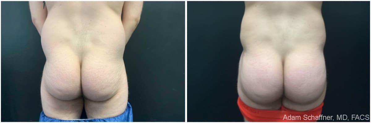 Liposuction with Fat Transfer to Buttocks (BBL – Brazilian Butt Lift) before and after result — Adam Schaffner, MD, FACS, New York City (case 5)