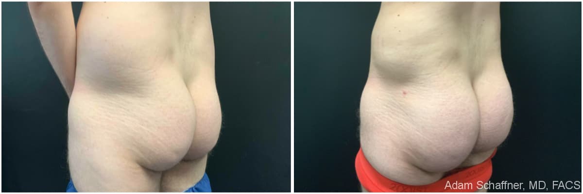 Liposuction with Fat Transfer to Buttocks (BBL – Brazilian Butt Lift) before and after result — Adam Schaffner, MD, FACS, New York City (case 4)