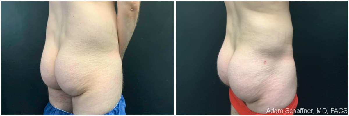 Liposuction with Fat Transfer to Buttocks (BBL – Brazilian Butt Lift) before and after result — Adam Schaffner, MD, FACS, New York City (case 3)