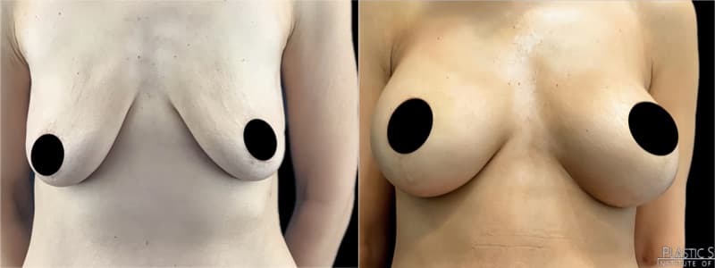 Breast Augmentation before and after result — Adam Schaffner, MD, FACS, New York City (case 2)