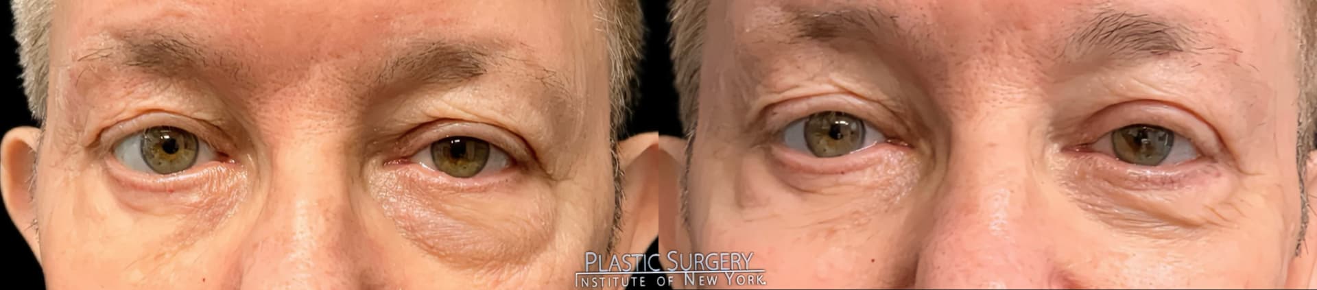 Blepharoplasty before and after result — Adam Schaffner, MD, FACS, New York City (case 6)