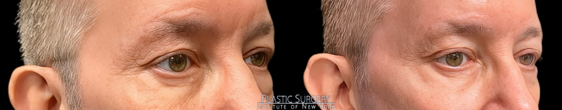 Blepharoplasty before and after result — Adam Schaffner, MD, FACS, New York City (case 5)