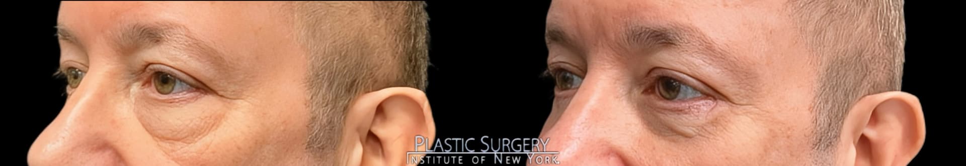 Blepharoplasty before and after result — Adam Schaffner, MD, FACS, New York City (case 2)