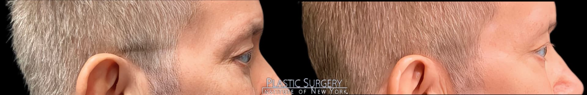 Blepharoplasty before and after result — Adam Schaffner, MD, FACS, New York City (case 3)