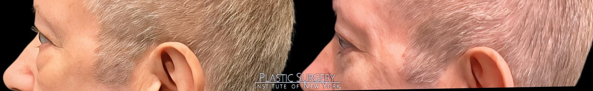 Blepharoplasty before and after result — Adam Schaffner, MD, FACS, New York City (case 4)
