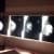 Do Breast Implants Get in the Way of a Mammogram?